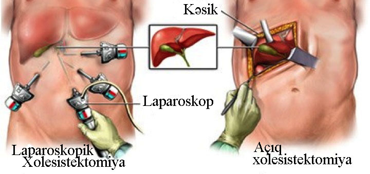 Xolesistoektamiya (öd daşı)